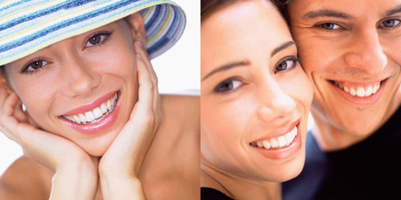 Veneers